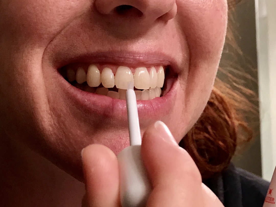 Whiter Teeth with Luster #teeth #beauty #luster #ad